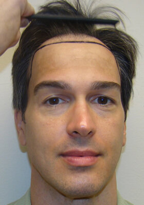 Dr Brett Bolton Patient Photos  - Jeff - One Procedure