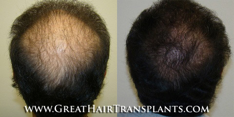 hair transplant cost