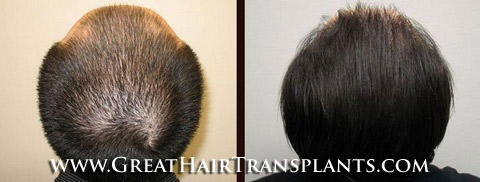 low cost hair transplants