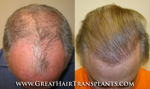 hair restoration