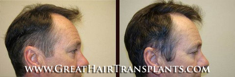 affordable hair transplants