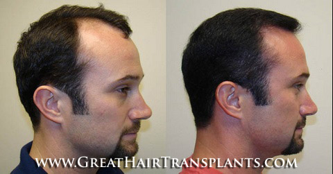 low cost hair transplant