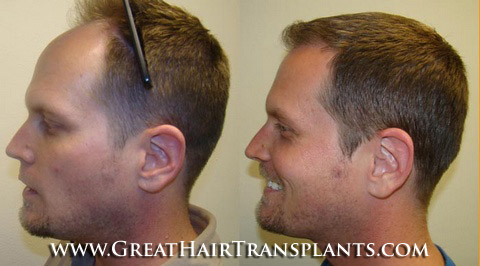 hair transplants