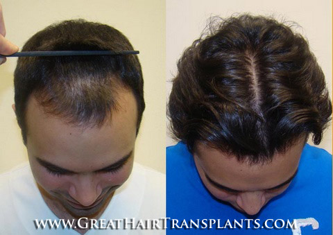 affordable hair transplants