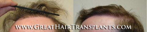 hair implants