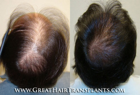 low cost hair transplants