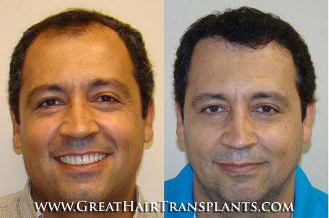 hair implants