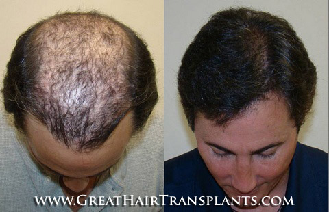 hair implant