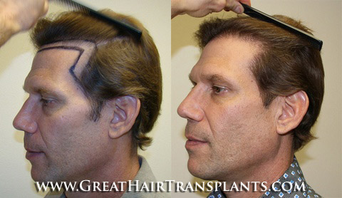 hair implant
