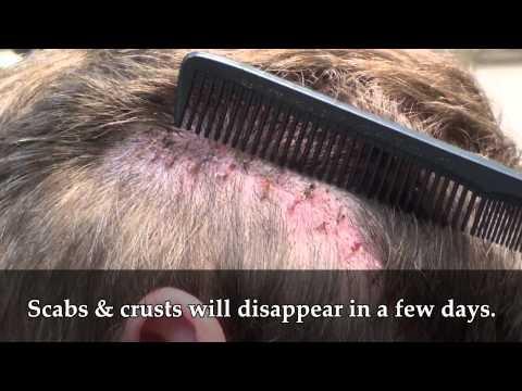 Hair Transplant Video