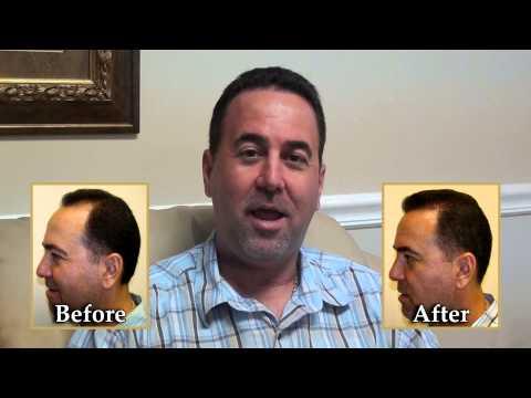 Hair Transplant Videos