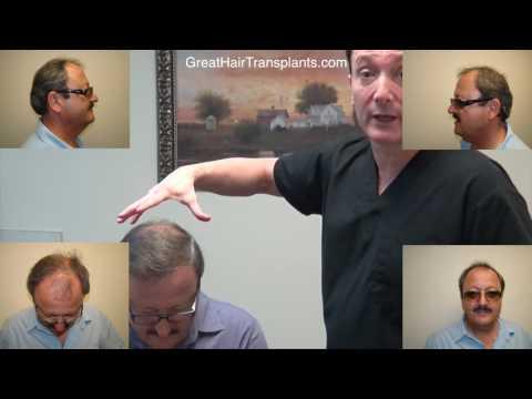 Hair Transplant Videos