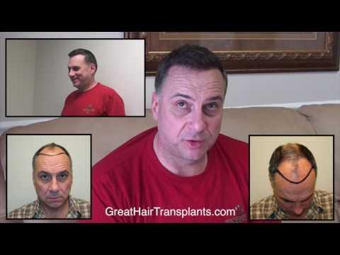 Hair Transplant Video