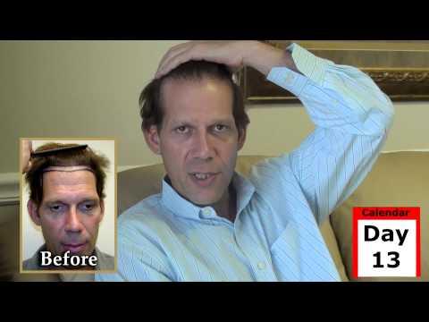 Hair Transplant Video