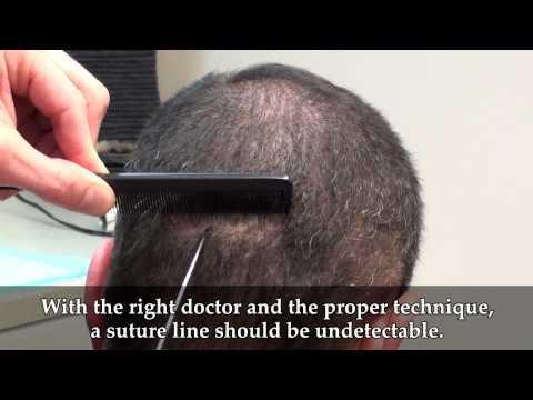 Hair Transplant Video