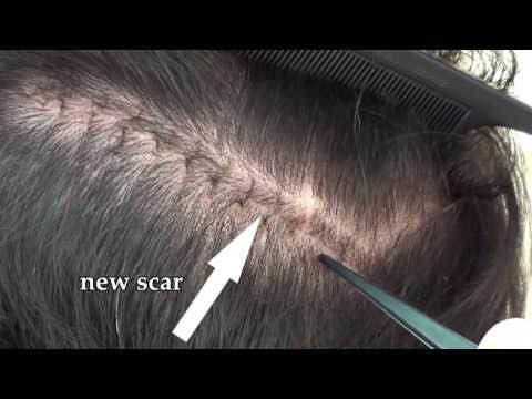 Hair Transplant Video