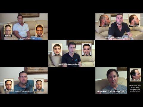 Hair Transplant Videos