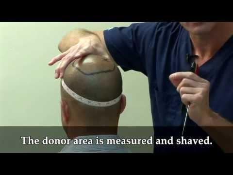 Hair Transplant Videos