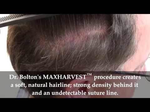 Hair Transplant Videos