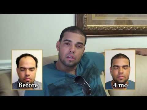 Hair Transplant Video