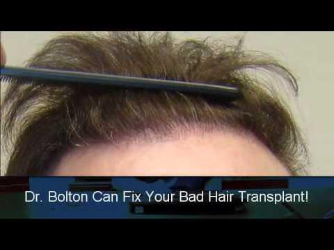 Hair Transplant Video