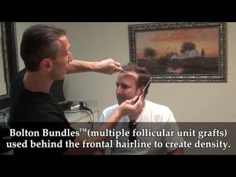 Hair Transplant Video