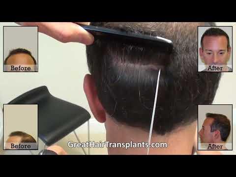 Hair Transplant Video
