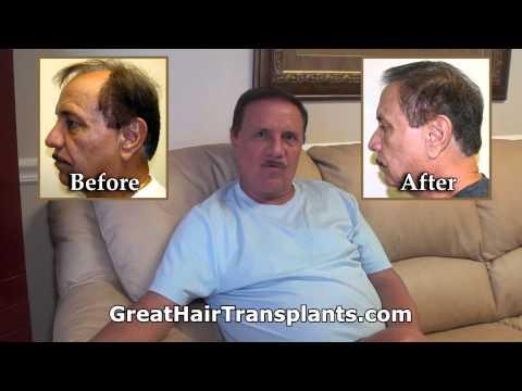 Hair Transplant Video