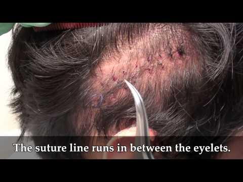 Hair Transplant Video