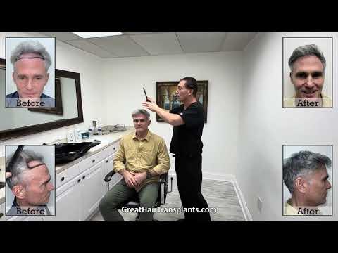 Hair Transplant Video