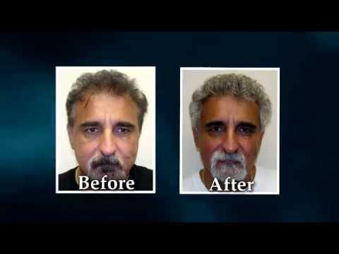 Hair Transplant Video