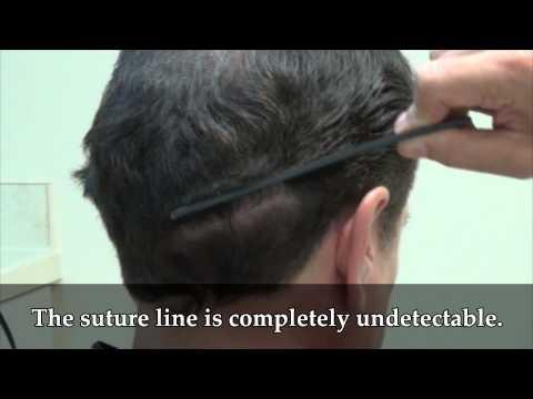 Hair Transplant Video