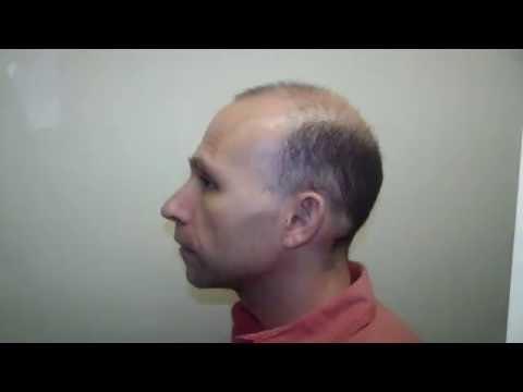 Hair Transplant Videos