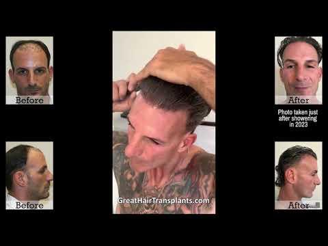 Hair Transplant Video