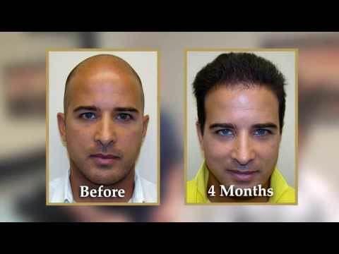 Hair Transplant Video