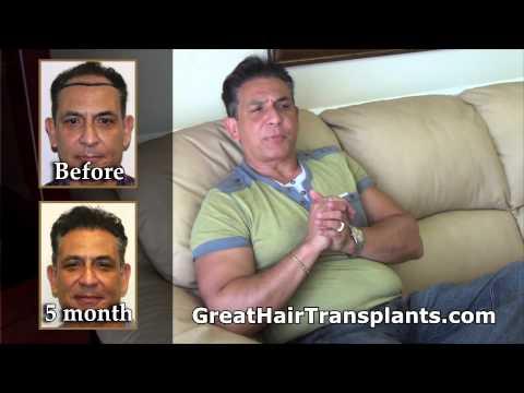 Hair Transplant Videos