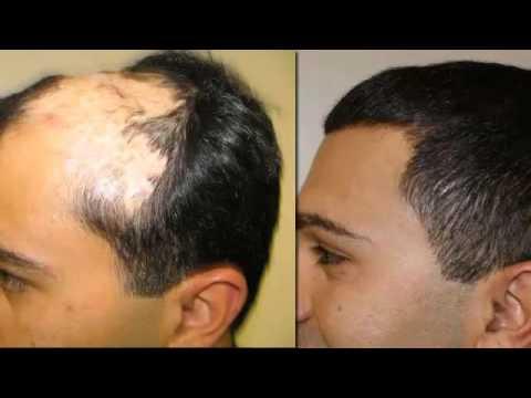 Hair Transplant Video