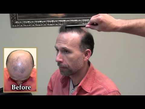 Hair Transplant Videos