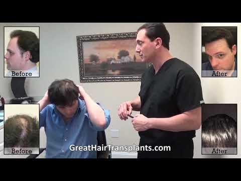 Hair Transplant Videos