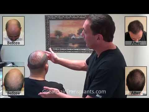 Hair Transplant Video