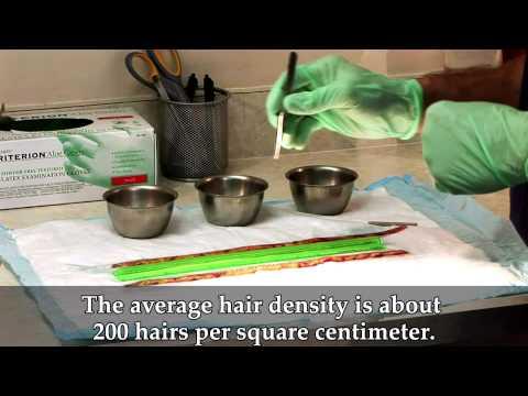 Hair Transplant Video