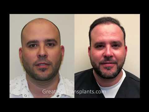 Hair Transplant Video