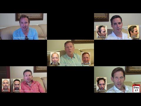 Hair Transplant Videos