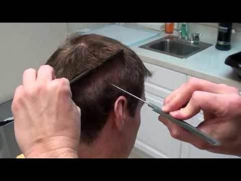 Hair Transplant Videos