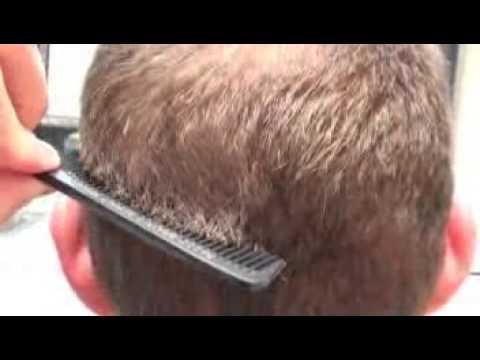 Hair Transplant Videos