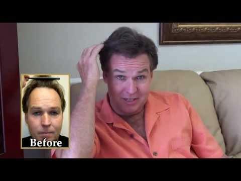 Hair Transplant Video