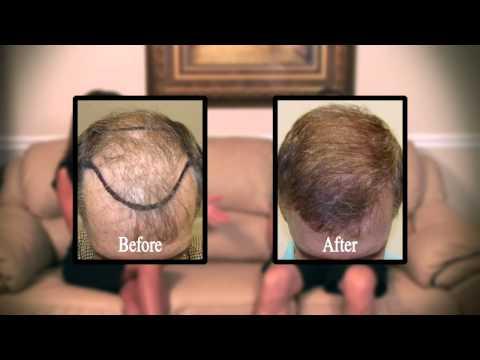 Hair Transplant Videos