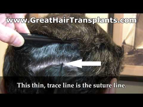 Hair Transplant Video