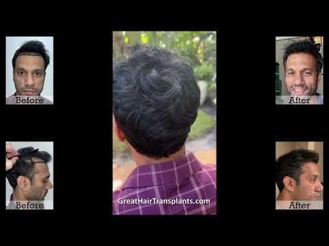 Hair Transplant Video