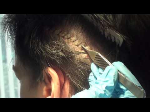 Hair Transplant Video